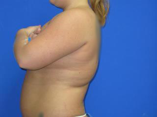 VASER Liposuction Before & After Patient #7156