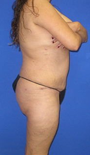 VASER Liposuction Before & After Patient #7161