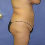 VASER Liposuction Before & After Patient #7164
