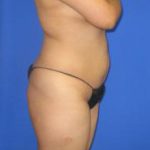 VASER Liposuction Before & After Patient #7167