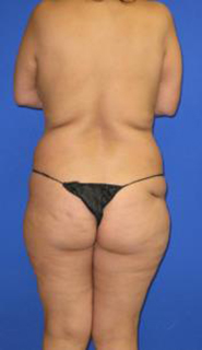 VASER Liposuction Before & After Patient #7170