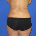 VASER Liposuction Before & After Patient #7170