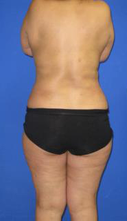 VASER Liposuction Before & After Patient #7170