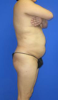 VASER Liposuction Before & After Patient #7178