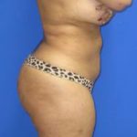 VASER Liposuction Before & After Patient #7253