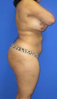 VASER Liposuction Before & After Patient #7253