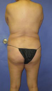 VASER Liposuction Before & After Patient #7181