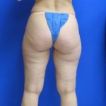 VASER Liposuction Before & After Patient #7187