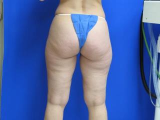 VASER Liposuction Before & After Patient #7187