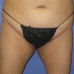 VASER Liposuction Before & After Patient #7190