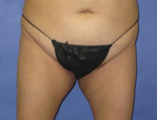 VASER Liposuction Before & After Patient #7190