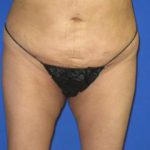 VASER Liposuction Before & After Patient #7190