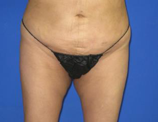 VASER Liposuction Before & After Patient #7190