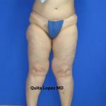 VASER Liposuction Before & After Patient #7193