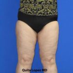VASER Liposuction Before & After Patient #7193
