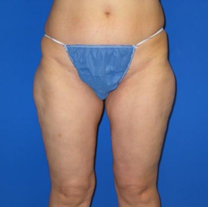 VASER Liposuction Before & After Patient #7197
