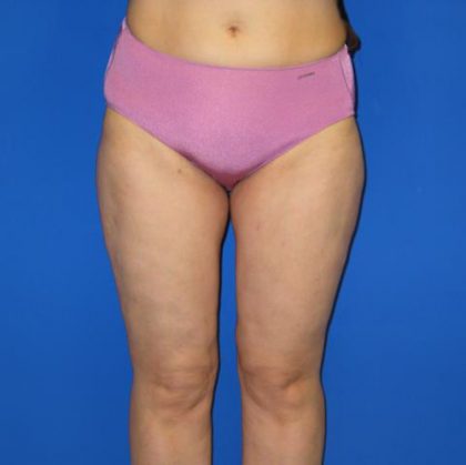 VASER Liposuction Before & After Patient #7197