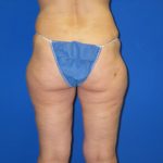 VASER Liposuction Before & After Patient #7197