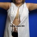 VASER Liposuction Before & After Patient #7208