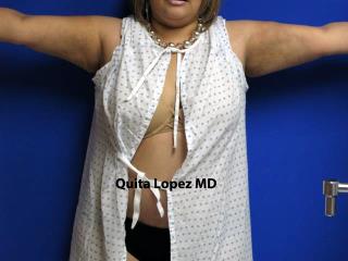 VASER Liposuction Before & After Patient #7208