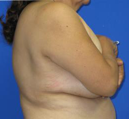 VASER Liposuction Before & After Patient #7228