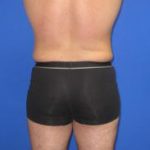 VASER Liposuction Hi-Def Before & After Patient #7233