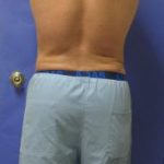 VASER Liposuction Hi-Def Before & After Patient #7233