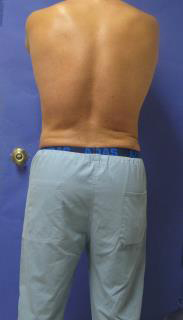 VASER Liposuction Hi-Def Before & After Patient #7233