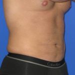 VASER Liposuction Hi-Def Before & After Patient #7233