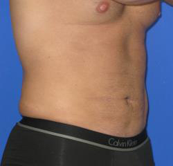 VASER Liposuction Hi-Def Before & After Patient #7233