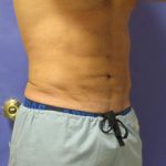 VASER Liposuction Hi-Def Before & After Patient #7233