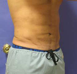 VASER Liposuction Hi-Def Before & After Patient #7233