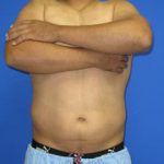 VASER Liposuction Hi-Def Before & After Patient #7238