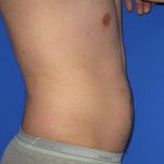 VASER Liposuction Before & After Patient #7241