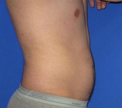 VASER Liposuction Before & After Patient #7241