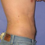 VASER Liposuction Before & After Patient #7241