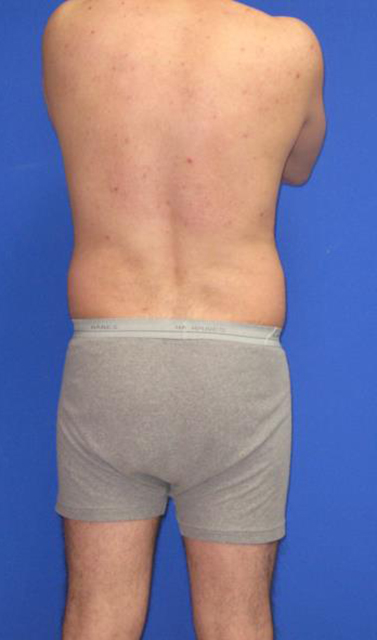 VASER Liposuction Before & After Patient #7244