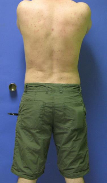 VASER Liposuction Before & After Patient #7244