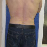 VASER Liposuction Before & After Patient #7247