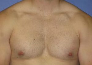 Gynecomastia Before & After Patient #1359