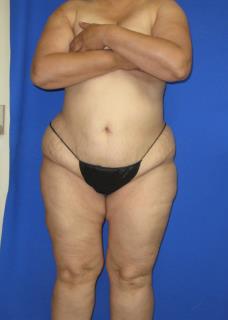 VASER Liposuction Before & After Patient #7256