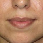 Lips Before & After Patient #732