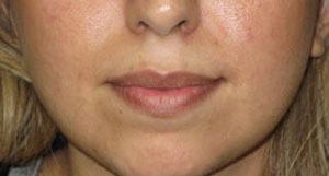 Lips Before & After Patient #732