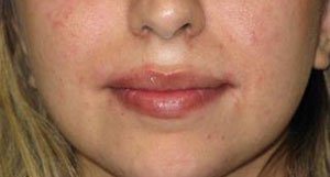 Lips Before & After Patient #732