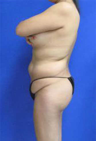 VASER Liposuction Before & After Patient #333