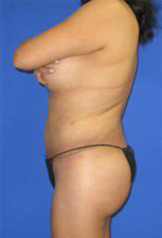 VASER Liposuction Before & After Patient #333