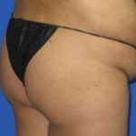 VASER Liposuction Before & After Patient #70
