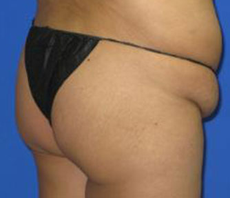 VASER Liposuction Before & After Patient #70