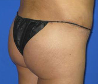 VASER Liposuction Before & After Patient #70