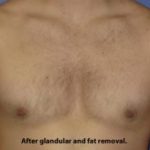 Gynecomastia Before & After Patient #1359